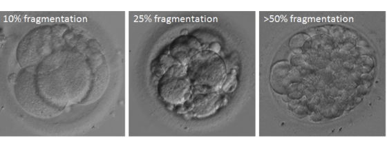 embryo-grading-davies-chicago-fertility-specialists-clinic-ivf-in